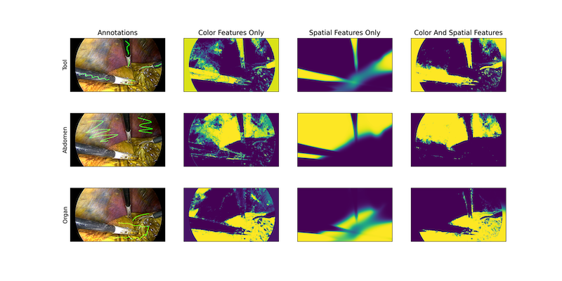 gaussian_mixture_models_MONAI – LearnOpenCV A visualization consisting of three rows, each demonstrating different segmentation scenarios using MONAI's Gaussian Mixture Models (GMM) applied to surgical imagery. Each row contains four images: the original annotated image (leftmost), segmentation using only color features, segmentation using only spatial features, and segmentation combining both color and spatial features (rightmost). The segmentation results clearly indicate that integrating both color and spatial features yields superior segmentation clarity and accuracy. This example highlights how MONAI's optimized Gaussian Mixture Models effectively differentiate tissues and surgical tools within complex medical images.