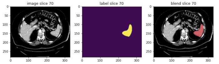 visualization_blend_MONAI – LearnOpenCV A visual representation showcasing MONAI’s advanced visualization tools. It consists of three images side-by-side: the first shows an original medical scan slice (image slice 70), the second displays the corresponding segmentation label highlighting a specific region, and the third image blends the original scan with its segmentation label clearly overlaying the segmented region in color. This illustration demonstrates MONAI's ability to visually assess and interpret model predictions, enhancing clinical review and decision-making beyond basic PyTorch visualization capabilities.